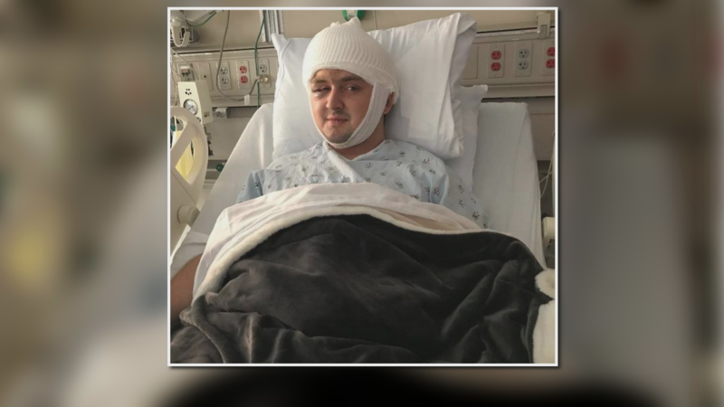 Dillon Steinfeldt after surgery to remove a brain tumor at the Mayo Clinic.